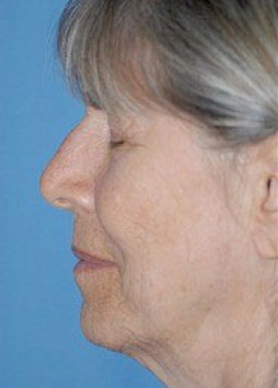 Plastic surgery patient at Allure Plastic Surgery