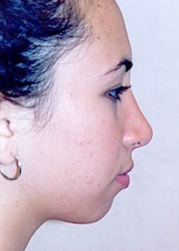 Plastic surgery patient at Allure Plastic Surgery