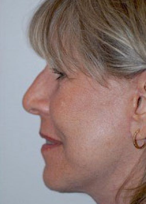 Facelift and Mini Facelift Before & After Gallery - Patient 5883750 - Image 2