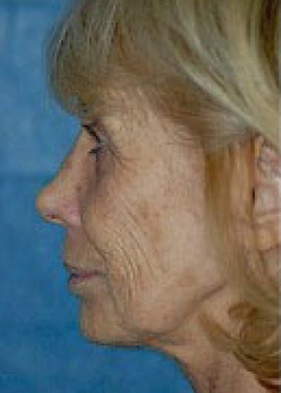 Laser Wrinkle Removal Before & After Gallery - Patient 5883752 - Image 1