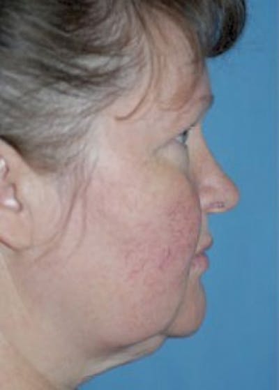 Facelift and Mini Facelift Gallery - Patient 5883753 - Image 1