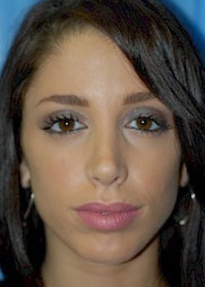 Rhinoplasty Before & After Gallery - Patient 5883755 - Image 2
