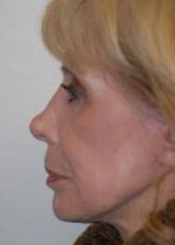 Laser Wrinkle Removal Before & After Gallery - Patient 5883752 - Image 2