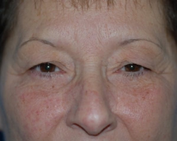 Eyelid Surgery Browlift Before & After Gallery - Patient 5883754 - Image 1