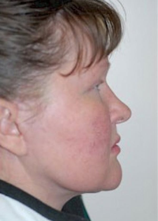 Facelift and Mini Facelift Before & After Gallery - Patient 5883753 - Image 2