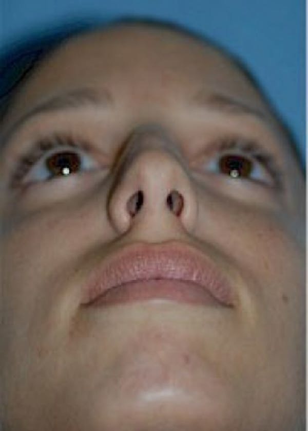 Rhinoplasty Before & After Gallery - Patient 5883755 - Image 3