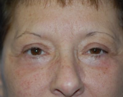 Eyelid Surgery Browlift Before & After Gallery - Patient 5883754 - Image 2