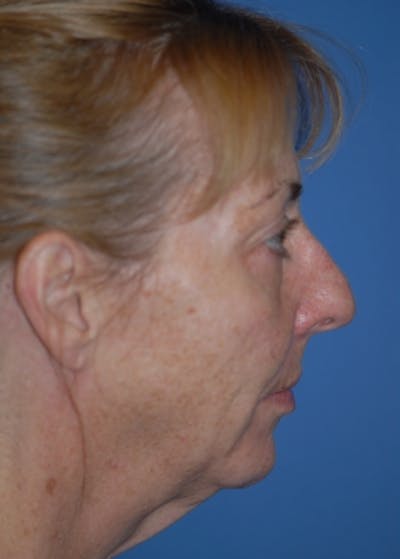 Facelift and Mini Facelift Before & After Gallery - Patient 5883766 - Image 1