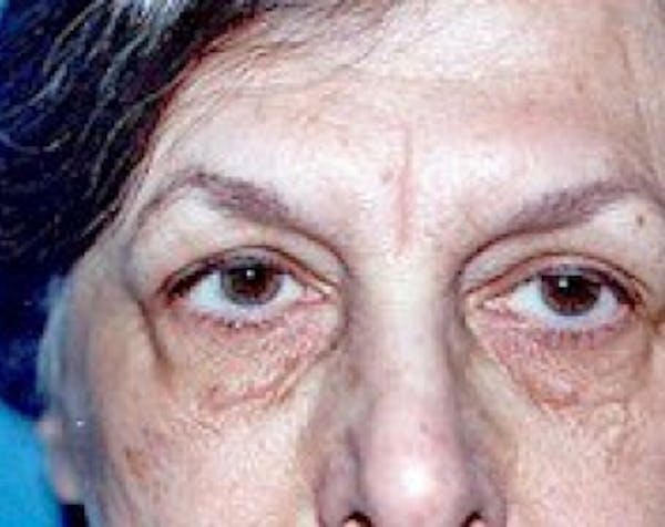 Eyelid Surgery Browlift Before & After Gallery - Patient 5883757 - Image 1