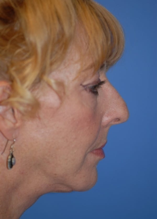 Facelift and Mini Facelift Before & After Gallery - Patient 5883766 - Image 2