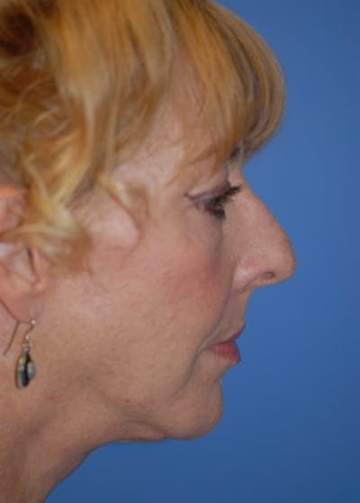 Facelift and Mini Facelift Gallery - Patient 5883766 - Image 2