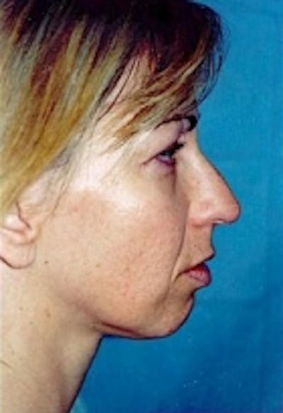 Plastic surgery patient at Allure Plastic Surgery