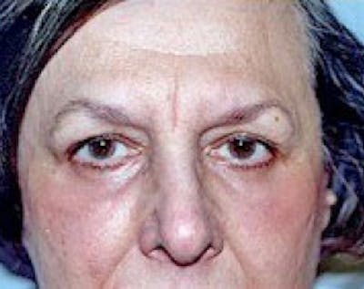 Eyelid Surgery Browlift Before & After Gallery - Patient 5883757 - Image 2