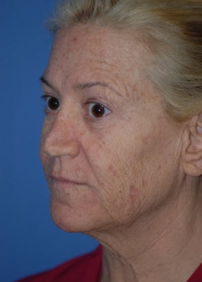 Laser Wrinkle Removal Before & After Gallery - Patient 5883762 - Image 1