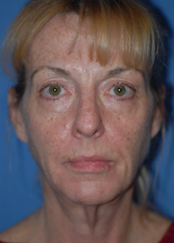Facelift and Mini Facelift Before & After Gallery - Patient 5883766 - Image 3