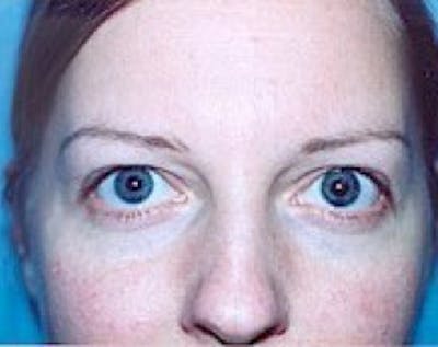 Eyelid Surgery Browlift Before & After Gallery - Patient 5883765 - Image 1