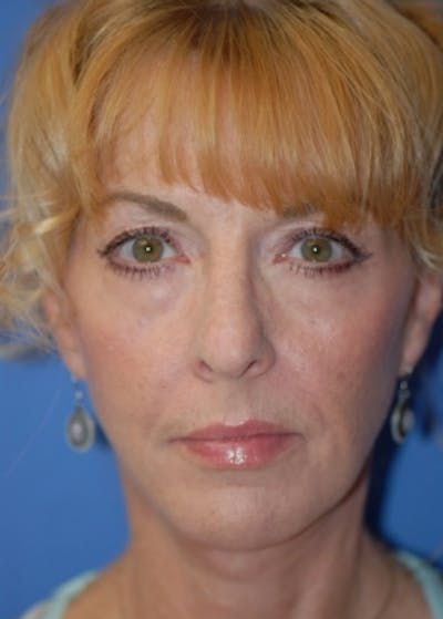 Facelift and Mini Facelift Before & After Gallery - Patient 5883766 - Image 4