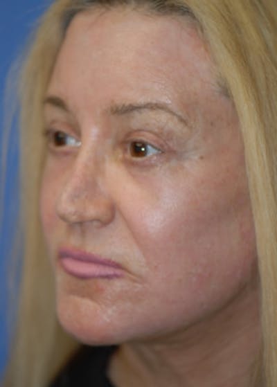 Laser Wrinkle Removal Before & After Gallery - Patient 5883762 - Image 2