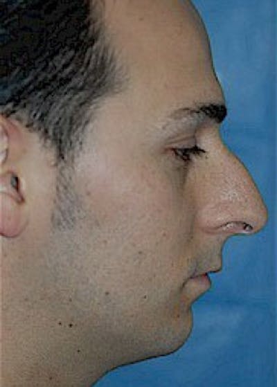 Plastic surgery patient at Allure Plastic Surgery