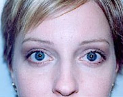 Eyelid Surgery Browlift Before & After Gallery - Patient 5883765 - Image 2