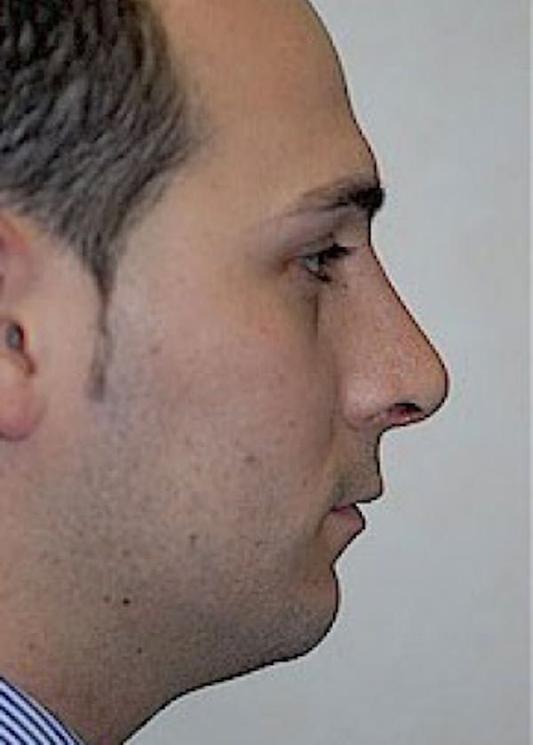 Rhinoplasty Before & After Gallery - Patient 5883767 - Image 2