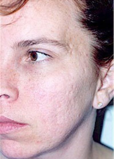 Laser Wrinkle Removal Before & After Gallery - Patient 5883769 - Image 1