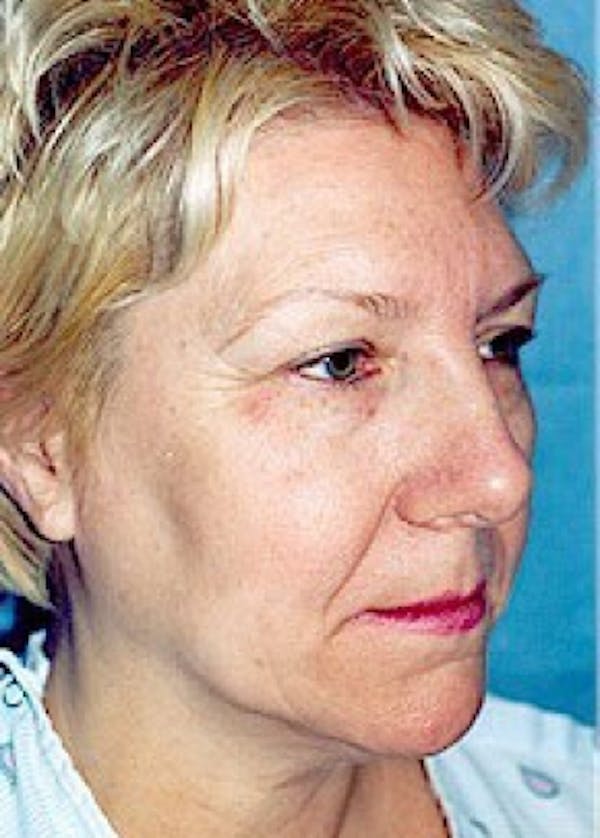 Facelift and Mini Facelift Gallery - Patient 5883772 - Image 1