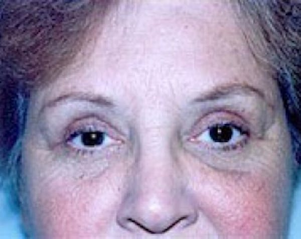 Eyelid Surgery Browlift Before & After Gallery - Patient 5883768 - Image 2