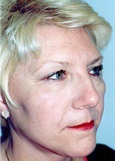 Facelift and Mini Facelift Gallery - Patient 5883772 - Image 2