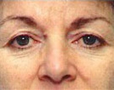 Eyelid Surgery Browlift Before & After Gallery - Patient 5883770 - Image 1