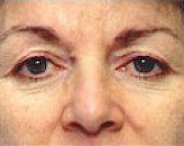 Eyelid Surgery Browlift Before & After Gallery - Patient 5883770 - Image 1