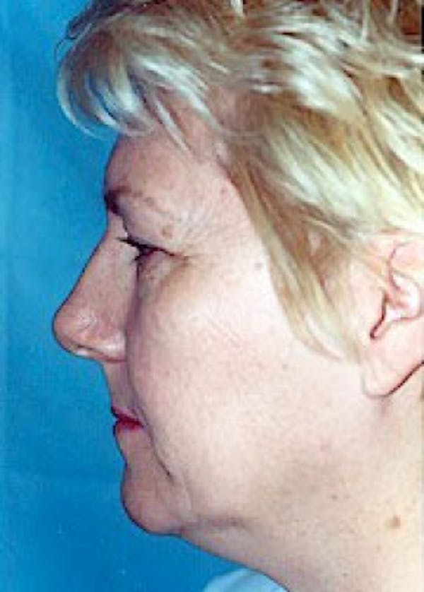 Facelift and Mini Facelift Before & After Gallery - Patient 5883772 - Image 3