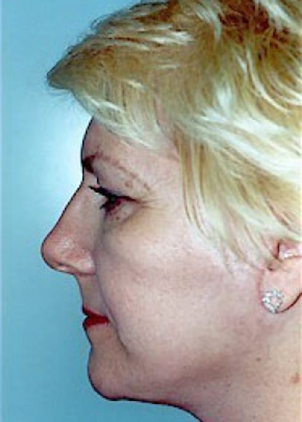 Facelift and Mini Facelift Before & After Gallery - Patient 5883772 - Image 4