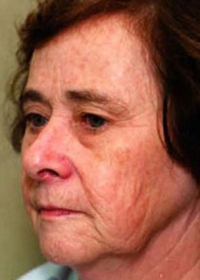 Laser Wrinkle Removal Gallery - Patient 5883776 - Image 1