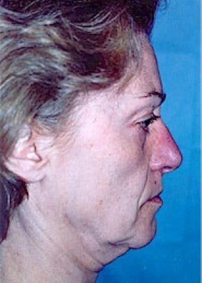 Facelift and Mini Facelift Gallery - Patient 5883778 - Image 1