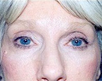 Eyelid Surgery Browlift Before & After Gallery - Patient 5883777 - Image 2
