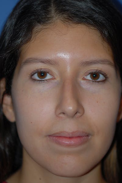 Rhinoplasty Before & After Gallery - Patient 5883787 - Image 1