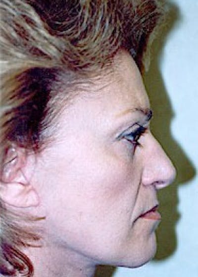 Facelift and Mini Facelift Before & After Gallery - Patient 5883778 - Image 2
