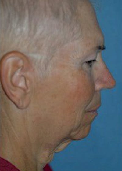 Facelift and Mini Facelift Before & After Gallery - Patient 5883782 - Image 1