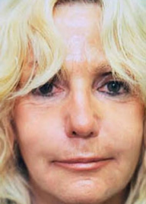 Laser Wrinkle Removal Gallery - Patient 5883781 - Image 2