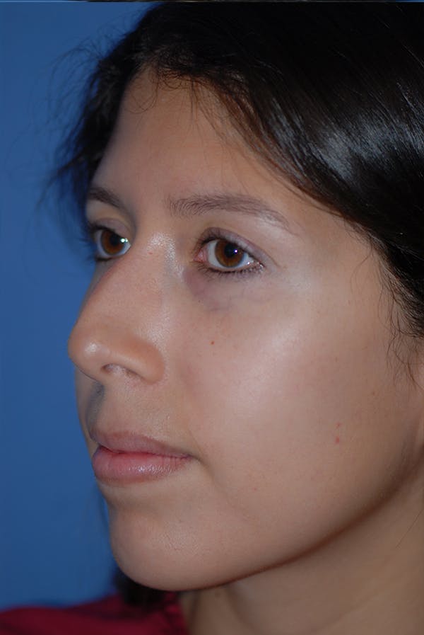 Rhinoplasty Before & After Gallery - Patient 5883787 - Image 3