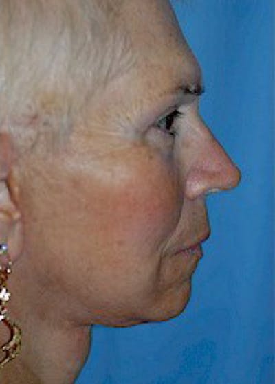 Facelift and Mini Facelift Before & After Gallery - Patient 5883782 - Image 2