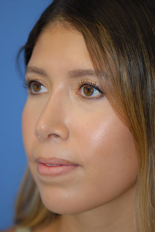 Rhinoplasty Before & After Gallery - Patient 5883787 - Image 4