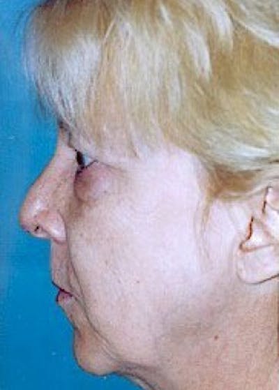 Facelift and Mini Facelift Gallery - Patient 5883785 - Image 1