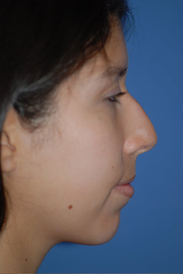 Rhinoplasty Before & After Gallery - Patient 5883787 - Image 5