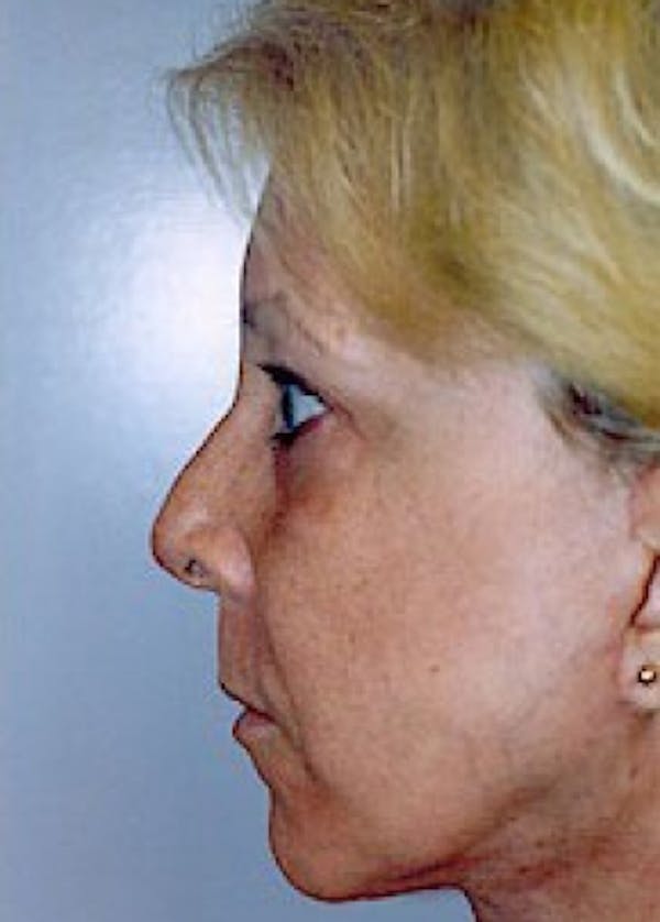 Facelift and Mini Facelift Before & After Gallery - Patient 5883785 - Image 2