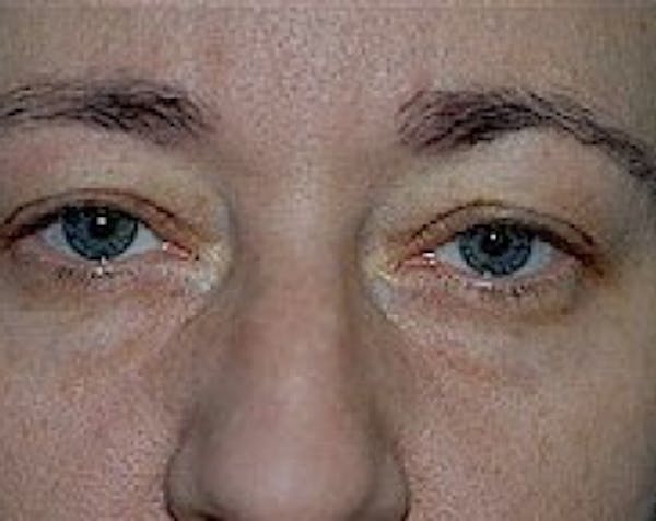 Eyelid Surgery Browlift Before & After Gallery - Patient 5883786 - Image 1
