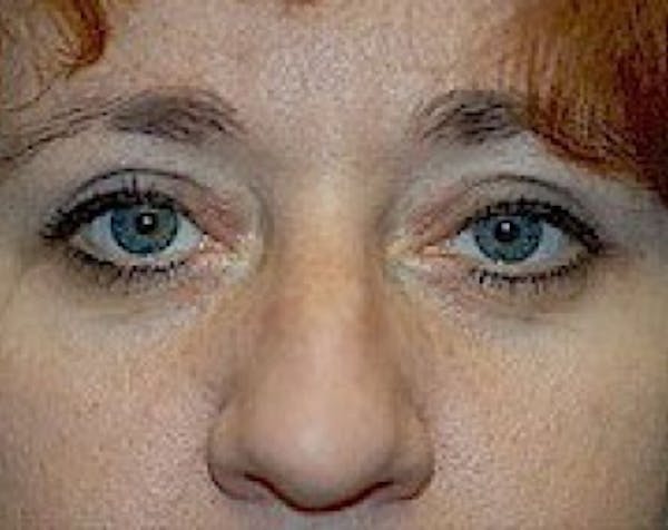 Eyelid Surgery Browlift Before & After Gallery - Patient 5883786 - Image 2