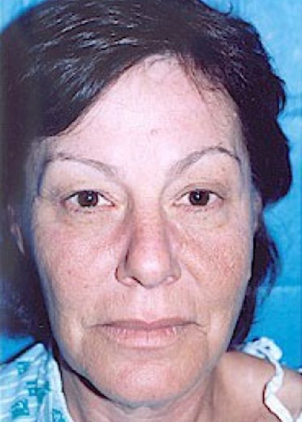 Eyelid Surgery Browlift Before & After Gallery - Patient 5883788 - Image 1