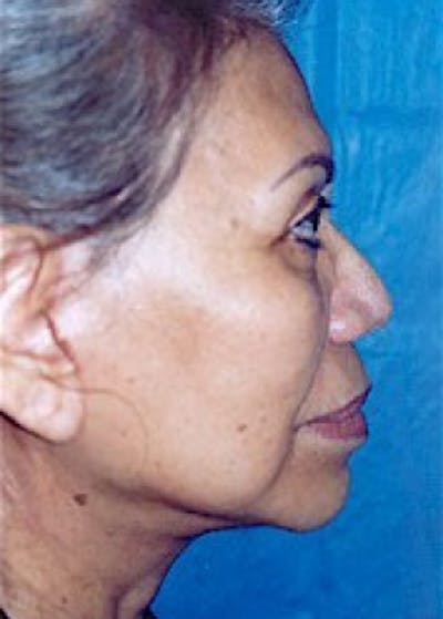 Facelift and Mini Facelift Before & After Gallery - Patient 5883791 - Image 2